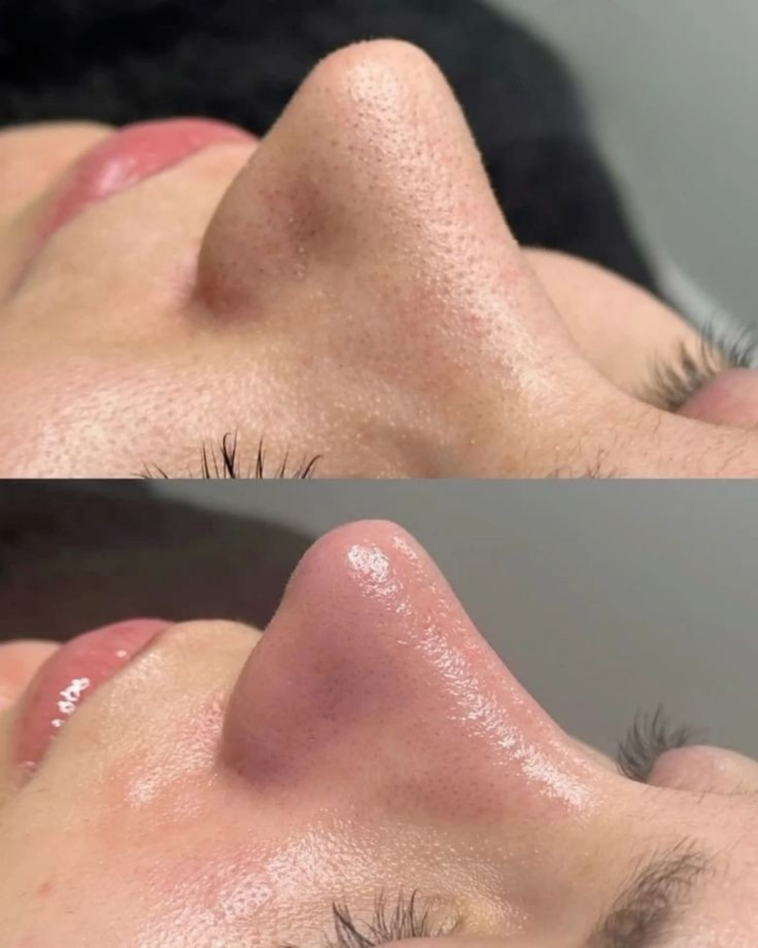 Peau_avant_et_apres_soin_Hydraface_nettoyage_en_profondeur_Givors