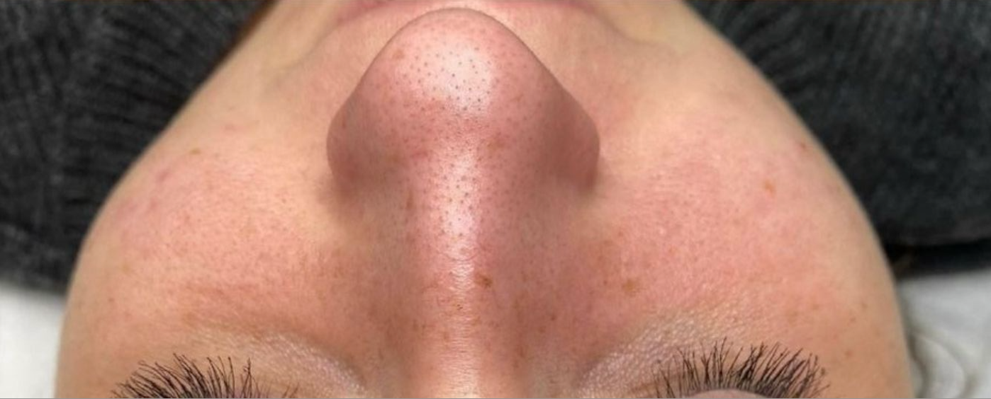Peau_avant_soin_Hydraface_nettoyage_de_peau_Givors