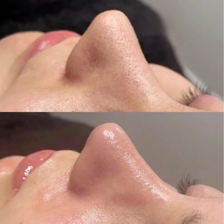 Soin Hydraface : avant et après, grain de peau lissé et teint plus lumineux