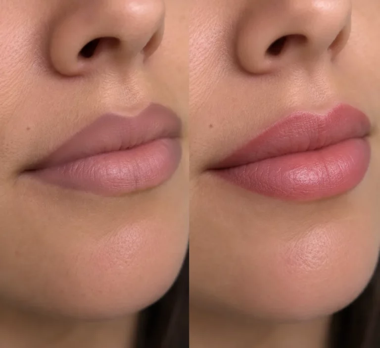Avant et après un cover des lèvres : couleur ravivée et contour harmonisé
